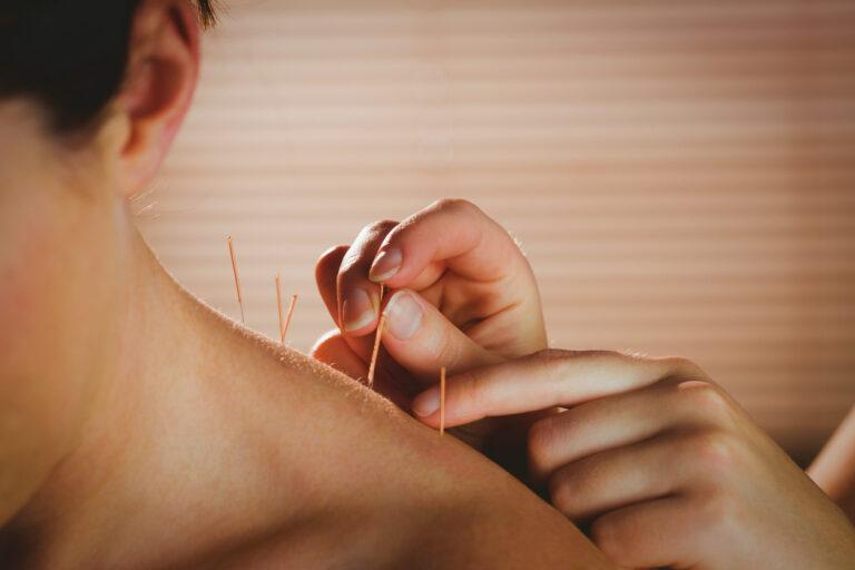 Does Dry Needling Work?